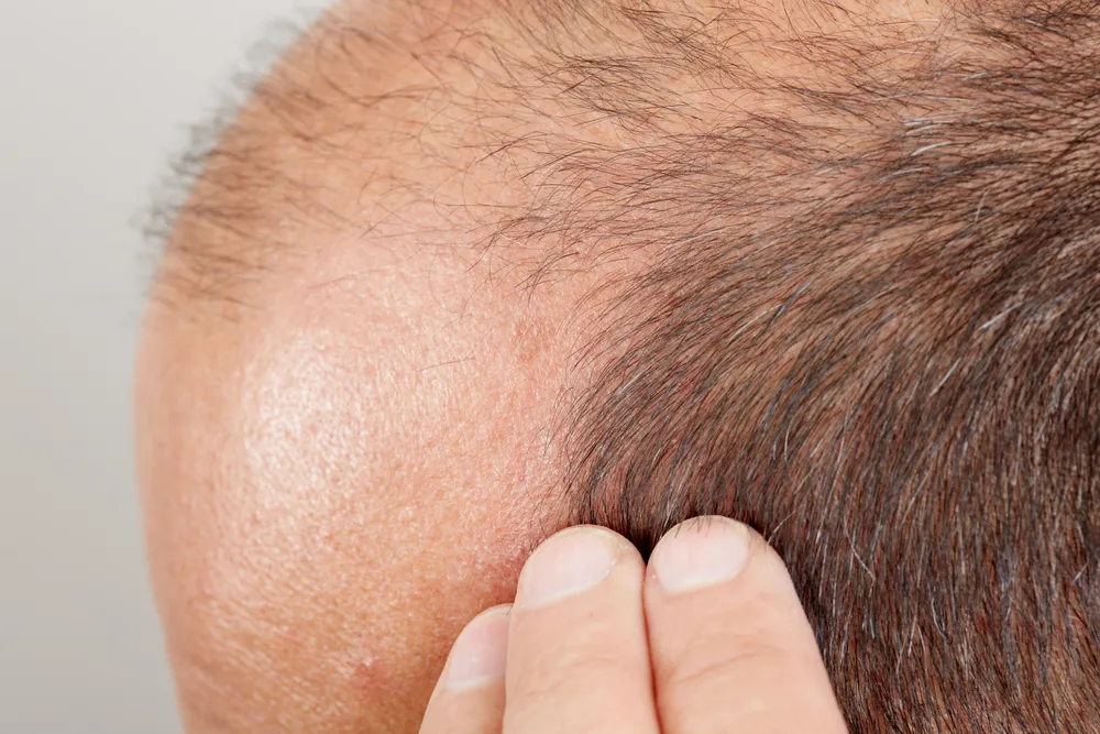 الصلع الوراثي